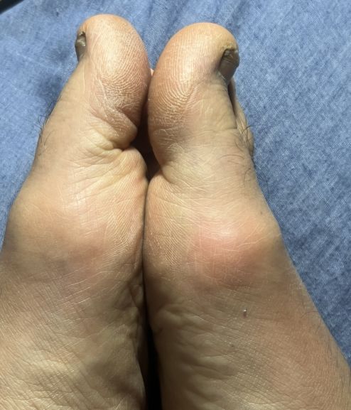 ルイボスティーの効果がすごい？痛風発作消滅で異次元レベルの体験！